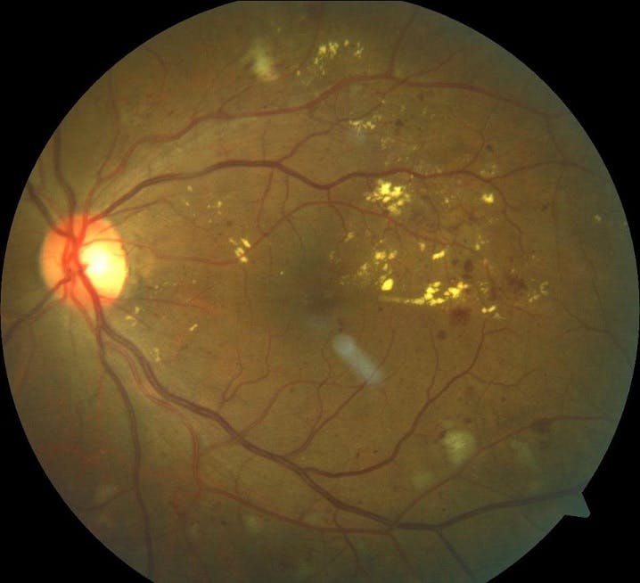https://covalentcareers3.s3.amazonaws.com/media/original_images/diabetic-retinopathy.jpg
