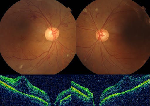 https://covalentcareers3.s3.amazonaws.com/media/original_images/diabetic_retinopathy_with_macular_edema.jpg