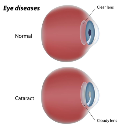 https://covalentcareers3.s3.amazonaws.com/media/original_images/eye-conditions-caused-by-diabetes-cataract.png