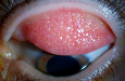 https://covalentcareers3.s3.amazonaws.com/media/original_images/giant-papillary-conjunctivitis-red-eye.png