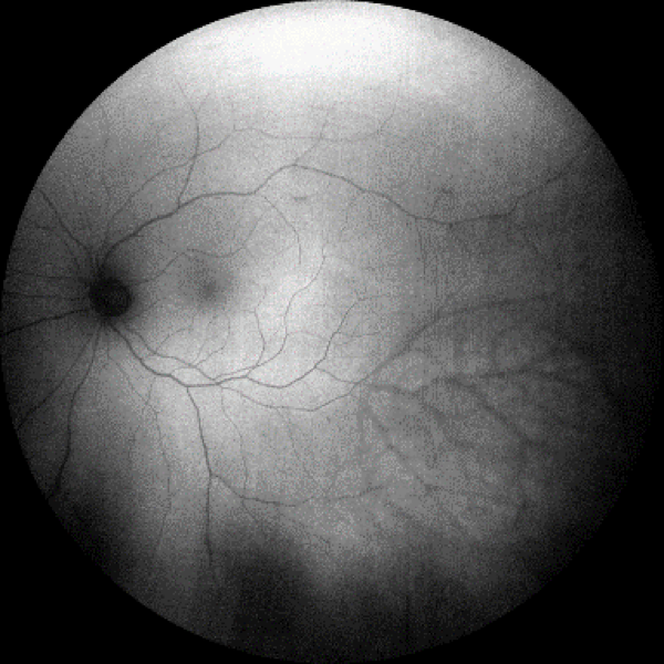 https://covalentcareers3.s3.amazonaws.com/media/original_images/inferior-temporal-retinoschisis-undilated-eye-taken-with-CLARUS-500.png