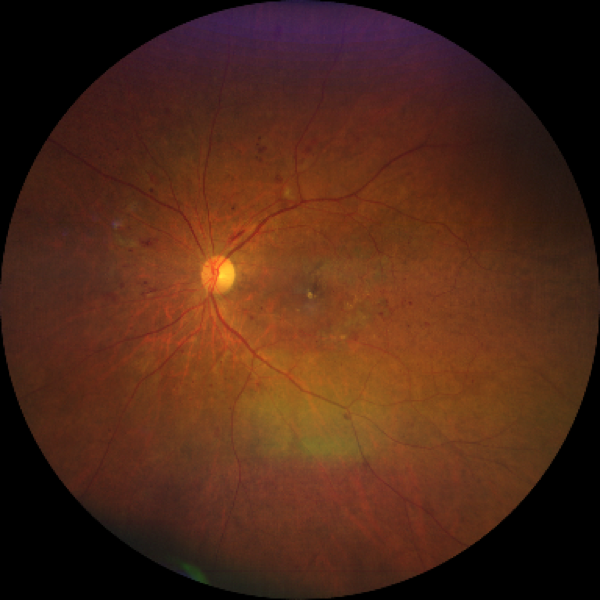 https://covalentcareers3.s3.amazonaws.com/media/original_images/midperipheral-and-diabetic-retinopathy-taken-with-CLARUS-500.png