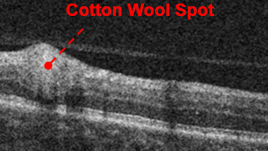 https://covalentcareers3.s3.amazonaws.com/media/original_images/oct-of-cotton-wool-spot-2.png