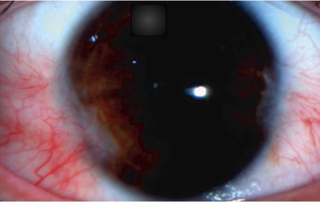 https://covalentcareers3.s3.amazonaws.com/media/original_images/pterygium-vs-pinguecula-what-to-know-and-how-to-treat-inread-image_1.png