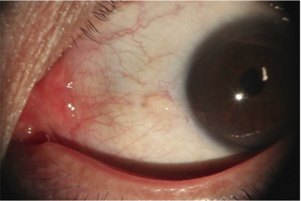 https://covalentcareers3.s3.amazonaws.com/media/original_images/pterygium-vs-pinguecula-what-to-know-and-how-to-treat-inread-image_3.png