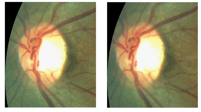 https://covalentcareers3.s3.amazonaws.com/media/original_images/retinal-image-glaucomatous-nerve-1-768x428.png