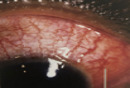 https://covalentcareers3.s3.amazonaws.com/media/original_images/scleritis-red-eye.png