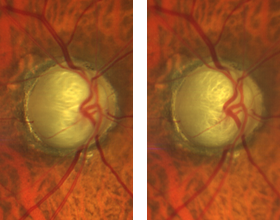 https://covalentcareers3.s3.amazonaws.com/media/original_images/stereo-images-of-optic-nerve-from-clarus-500.png