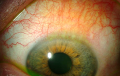 https://covalentcareers3.s3.amazonaws.com/media/original_images/superior-limbic-keratoconjunctivitis-red-eye.png