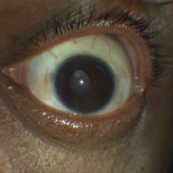 https://covalentcareers3.s3.amazonaws.com/media/original_images/traumatic-cataract-and-iridodialysis-taken-with-CLARUS-500.png