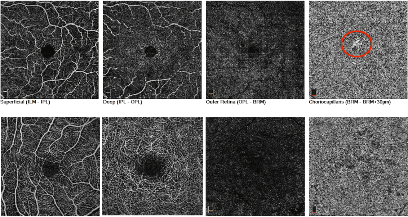 Cnv Macula Oct 5 Line Exposing Hidden Lesions: A Case of Non-Exudative Occult CNV