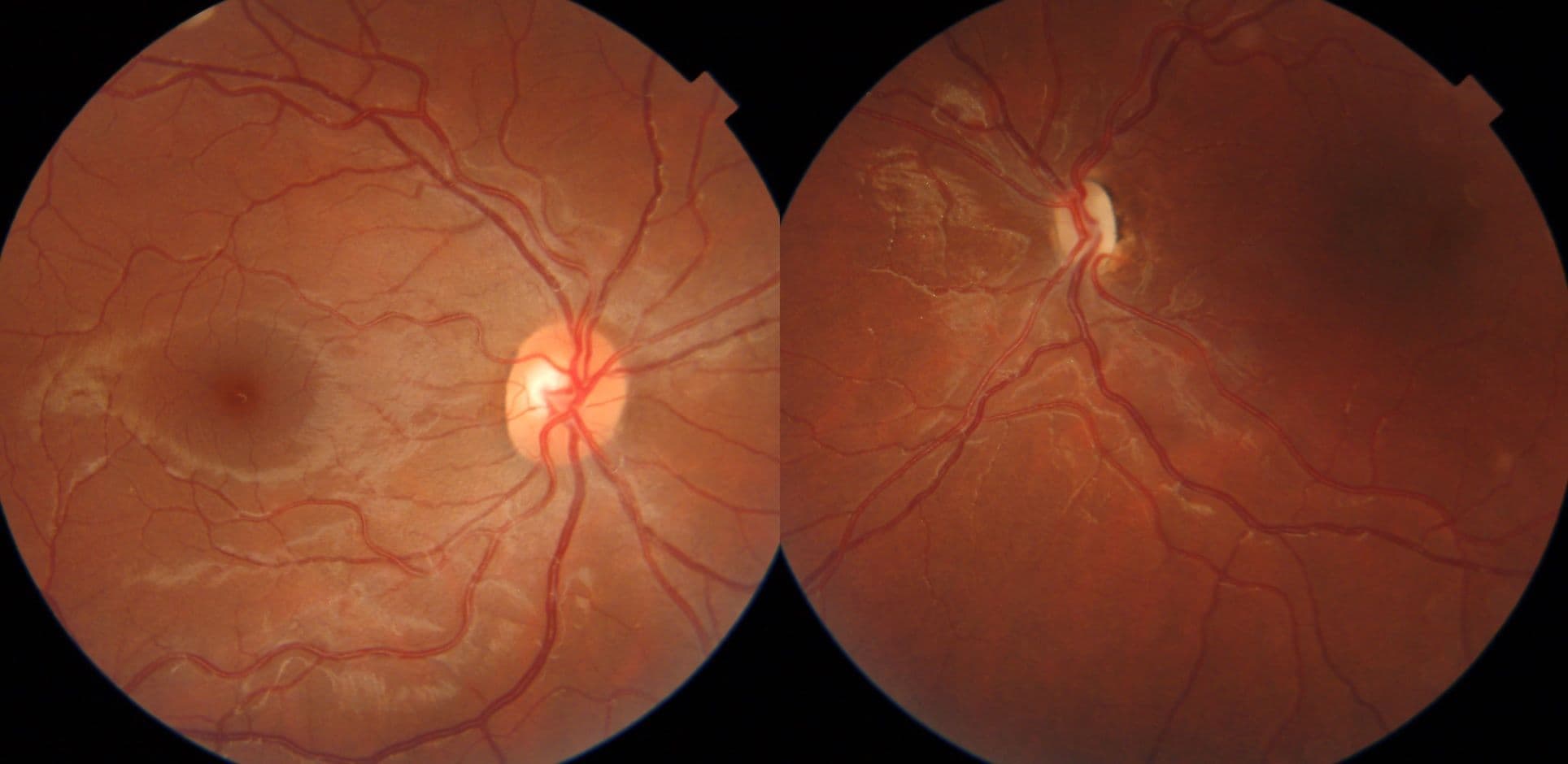 A Guide to Optic Disc Abnormalities with Cheat Sheet