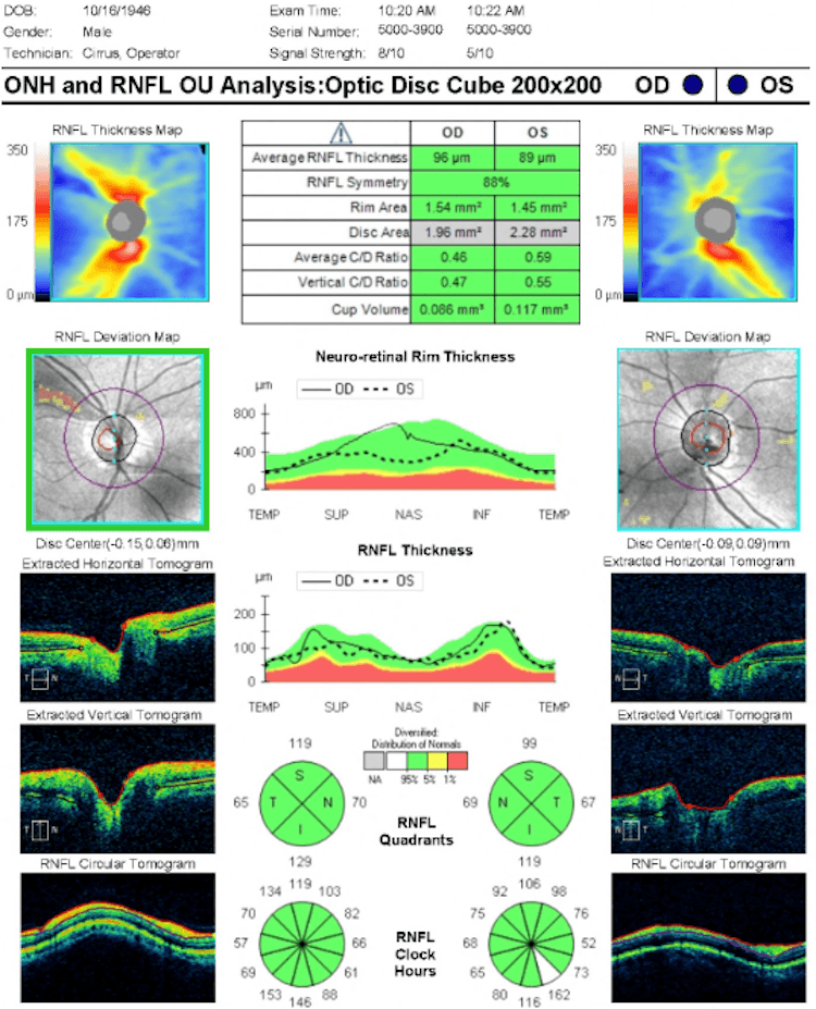 Appa Oct OCT Angiography in Glaucoma