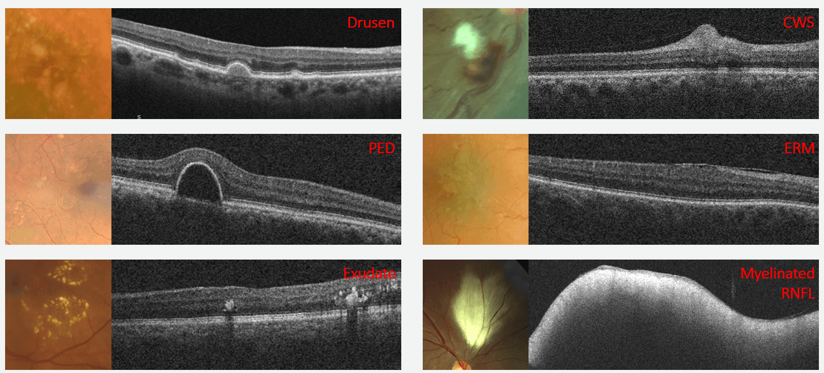 Retinal Undulation OCT Retinal Bootcamp