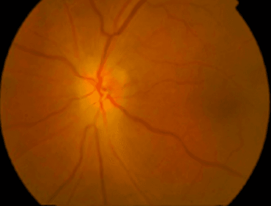 A Guide to Optic Disc Abnormalities with Cheat Sheet