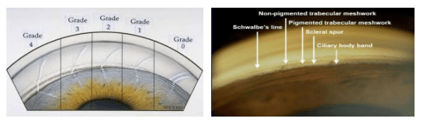 Primary Angle Closure: What Ophthalmology Residents Should Know