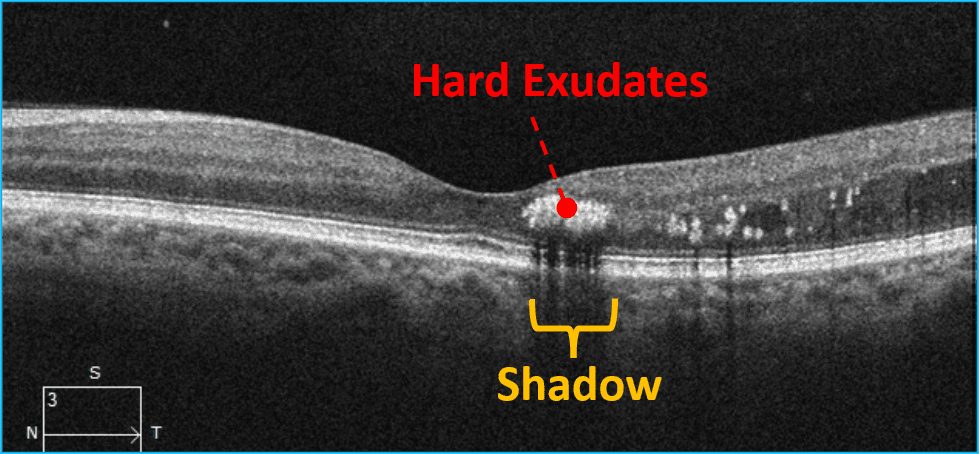 Into the Woods: Interpreting OCT Imaging in Retinal Disease