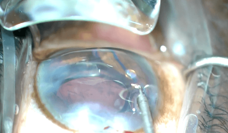 SION Goniotomy with Dr. Nathan Radcliffe