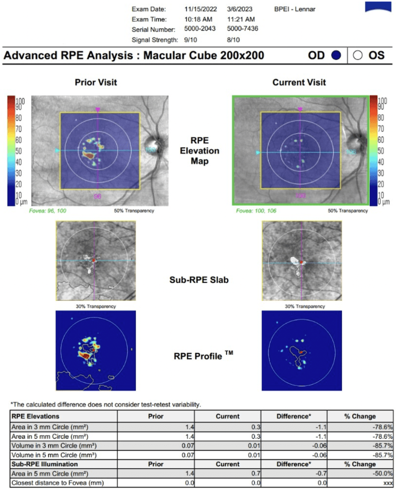 Progressive Atrophy Rpe Schematic A New Practice Pattern for Geographic Atrophy