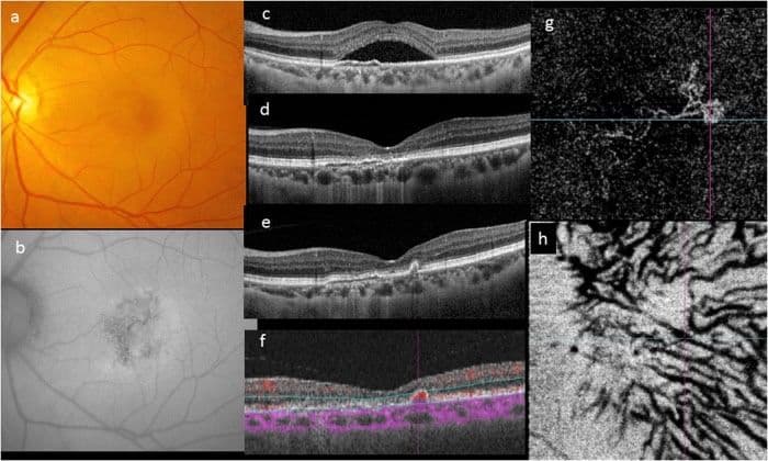 Normal Pachy An Optometrist's Guide to Pachychoroid Spectrum Conditions