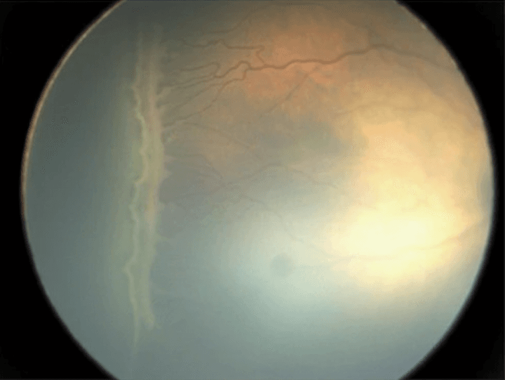 The Ultimate Guide to Identifying Retinal Disease on Fundus Photography