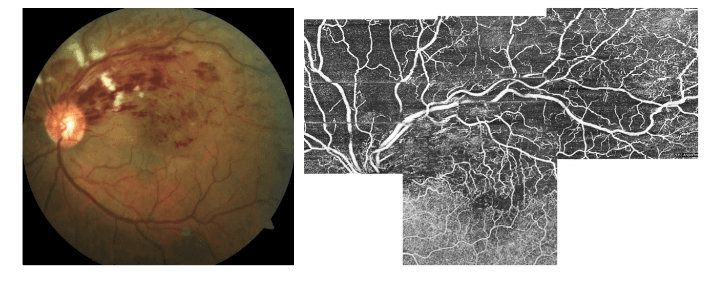 Octa Clean Eye Drop OCT Angiography: Routine to Extreme