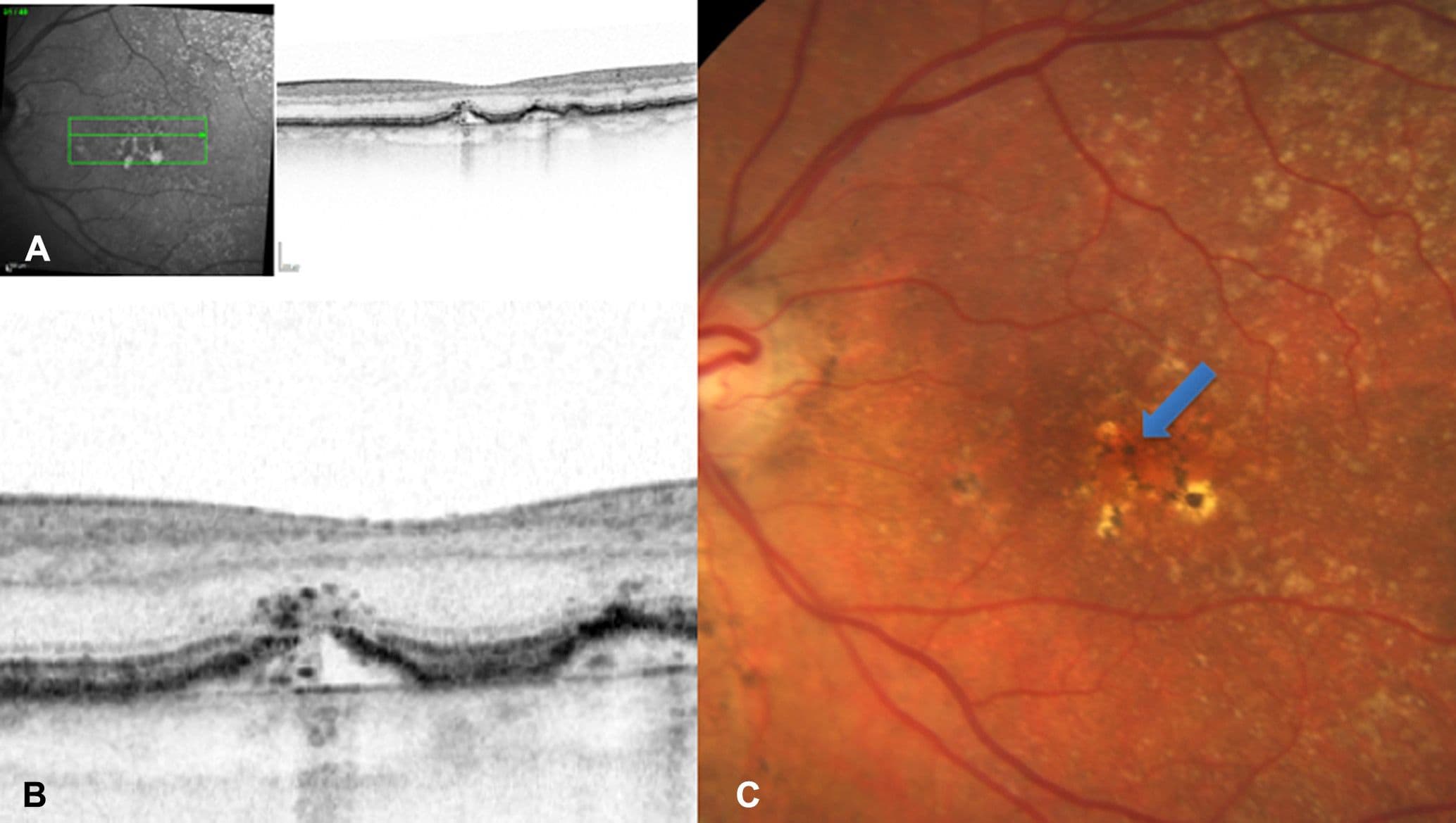 How To Accurately Stage Age-Related Macular Degeneration with Cheat Sheet