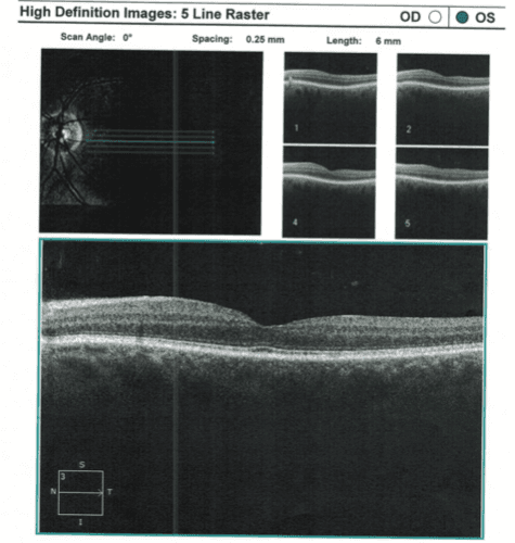 Oct 7 Line Raster 123s of Hydroxychloroquine Retinopathy