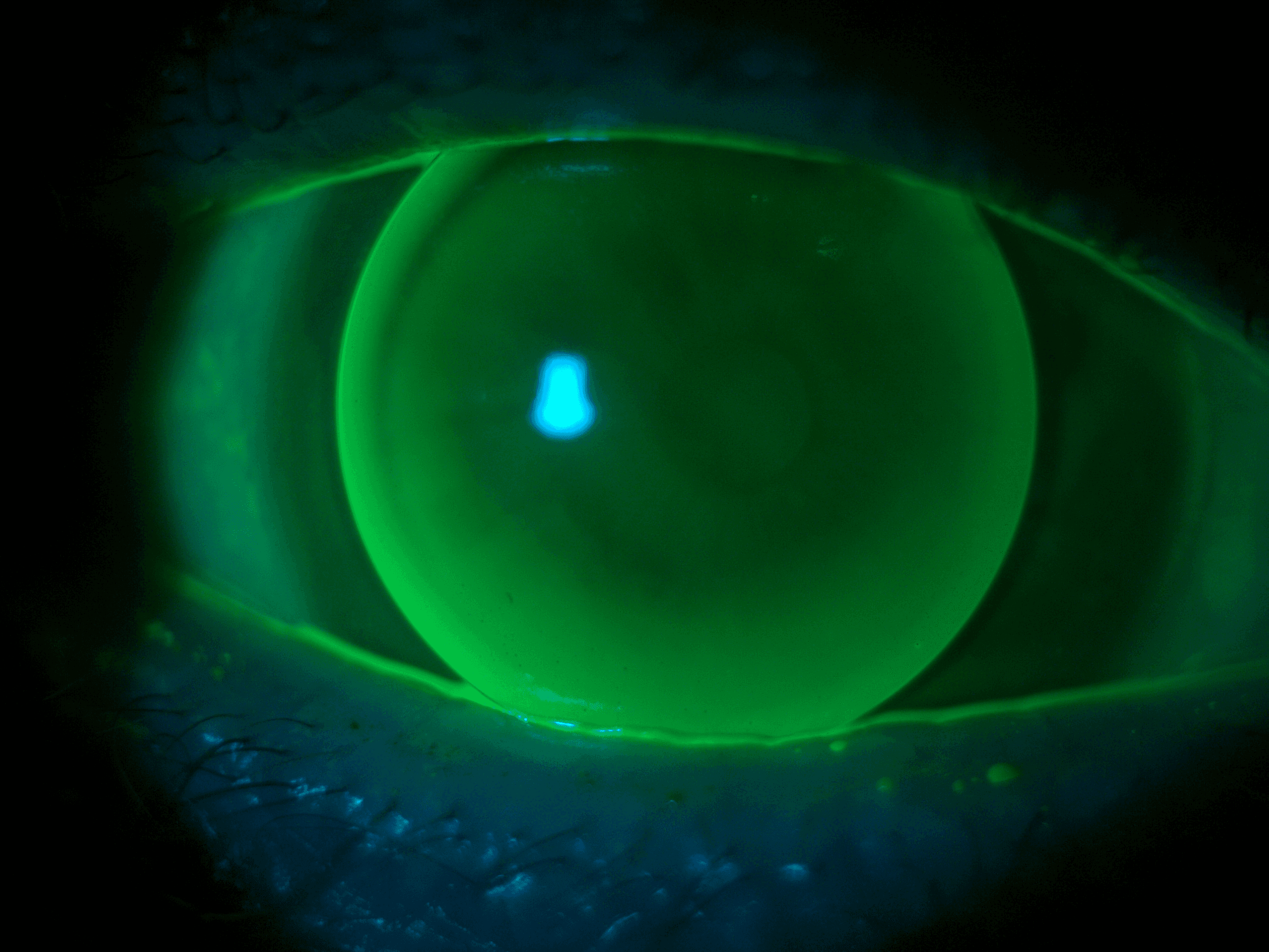 What to Know about Gas Permeable Lenses