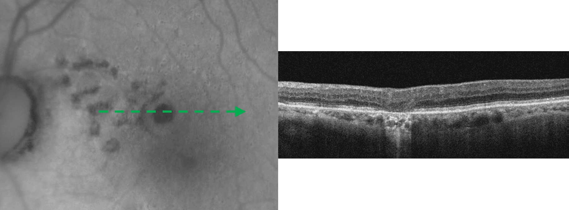 The Optometrist's Guide to Geographic Atrophy