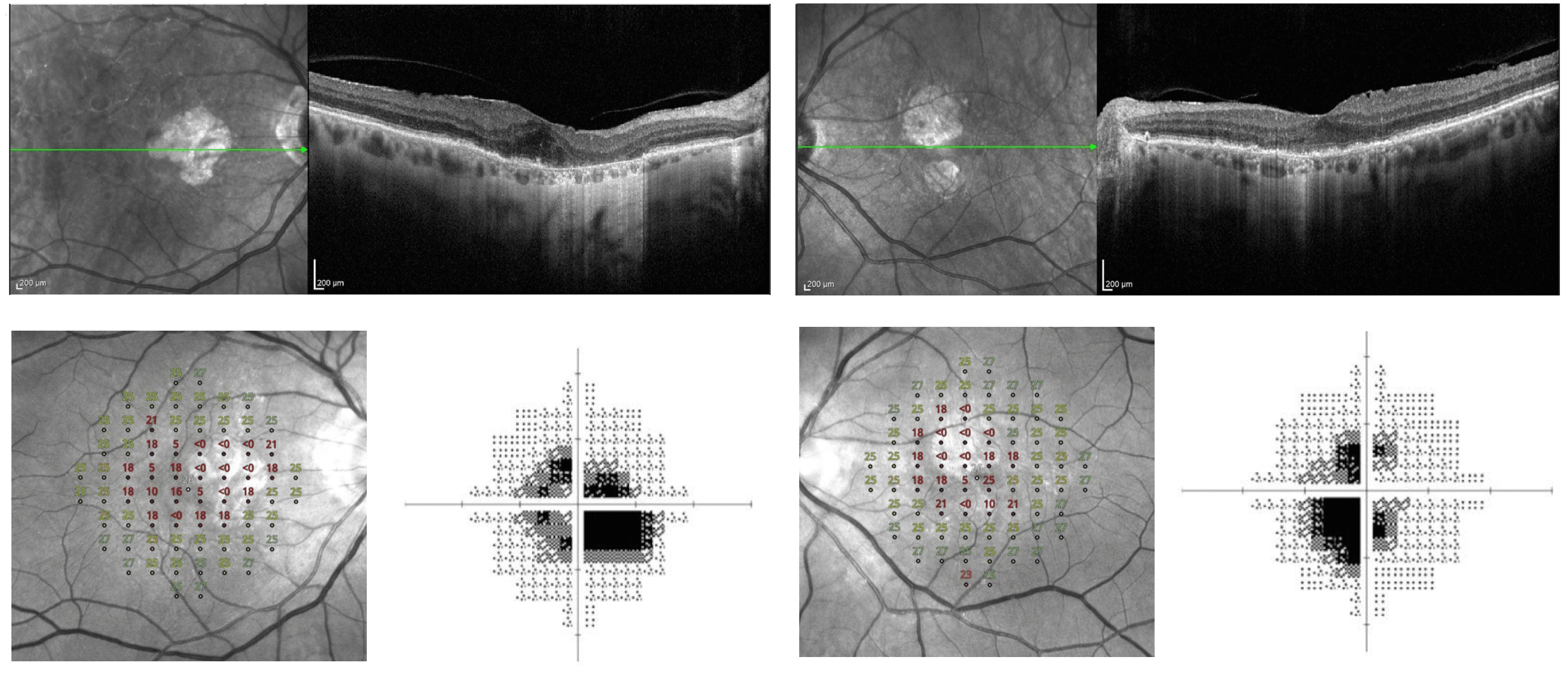 Ga Oct What Macular Degeneration to Geographic Atrophy Progression Really ...