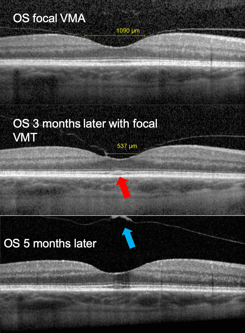 Step-by-Step Review and Pearls for Macular Hole Staging with Cheat Sheet