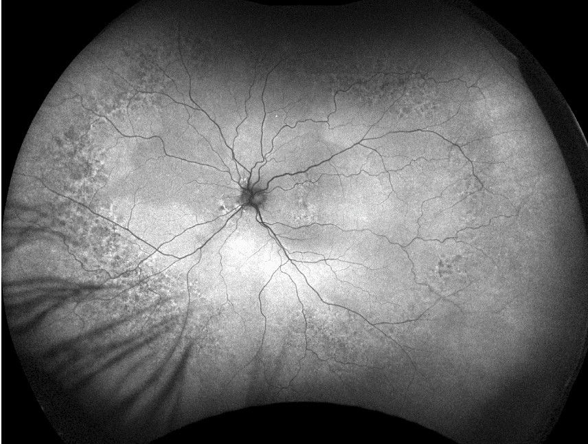 The Wide Spectrum of Peripheral Retinal Disease in AMD