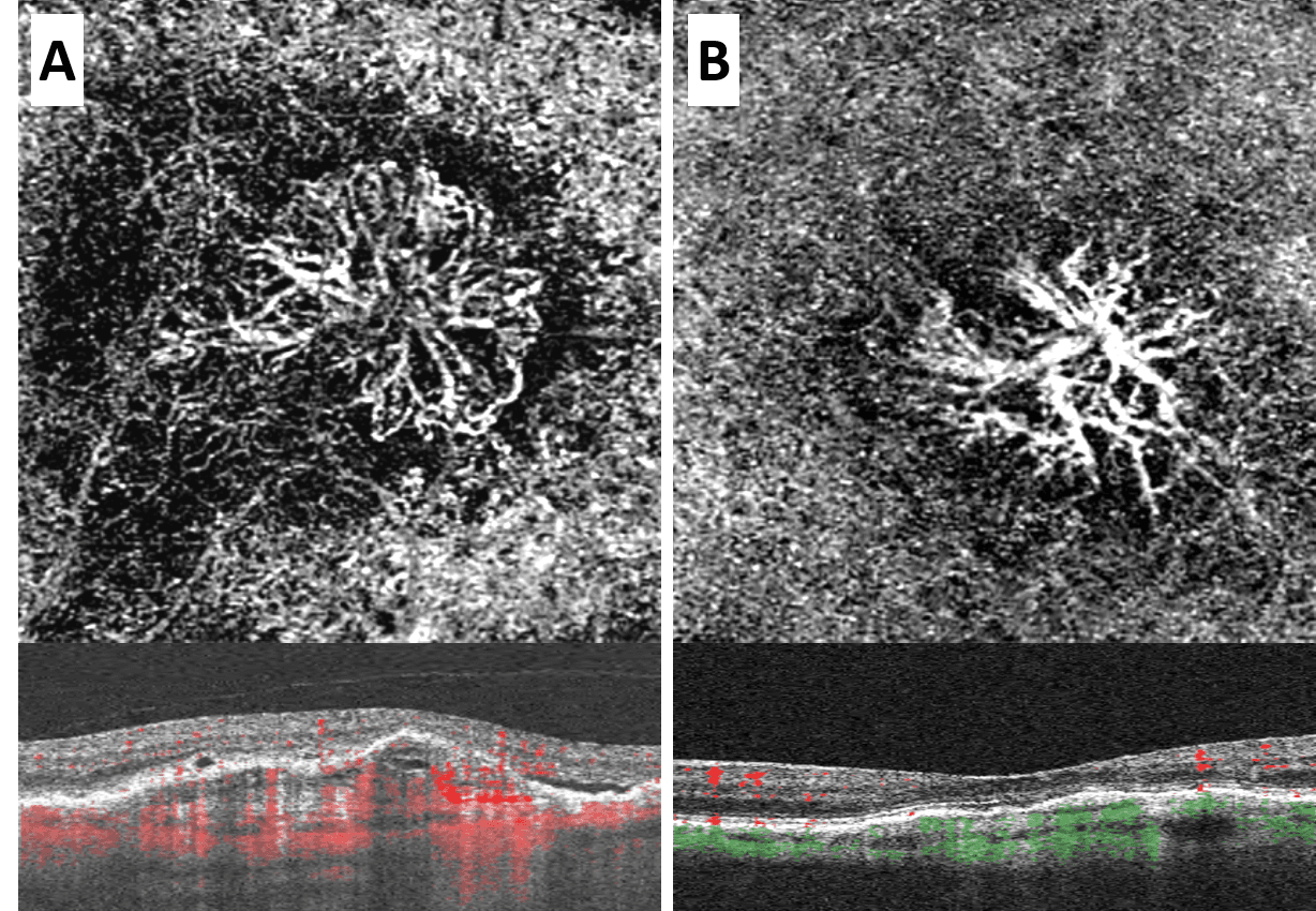 Into the Woods: Interpreting OCT Imaging in Retinal Disease