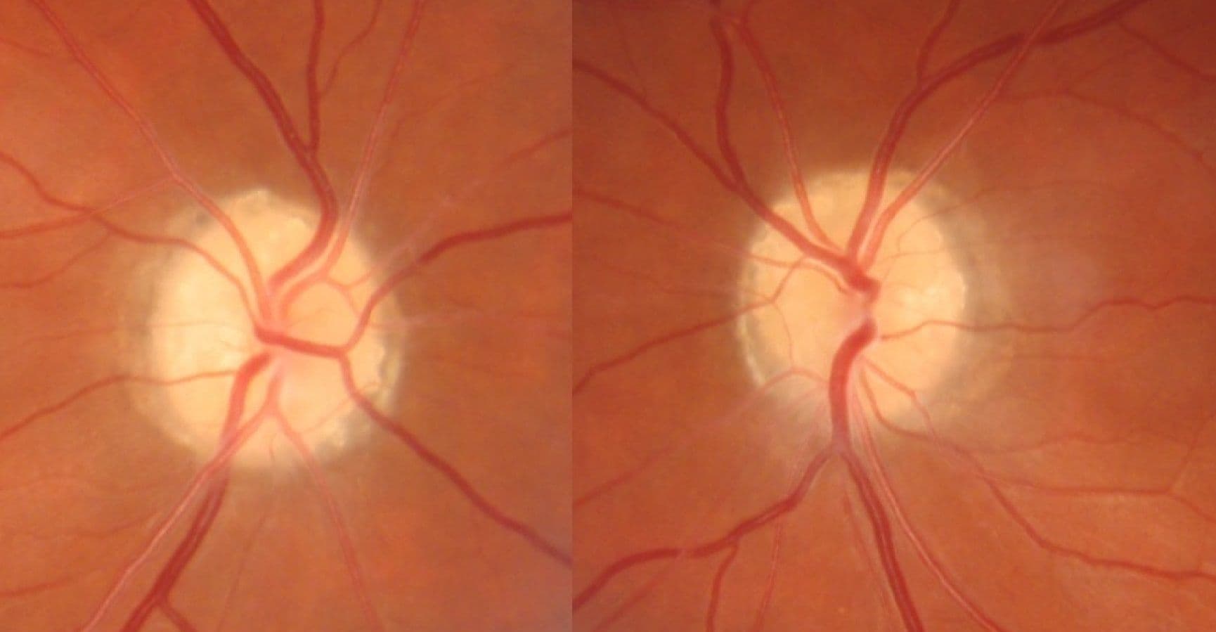 A Guide to Optic Disc Abnormalities with Cheat Sheet