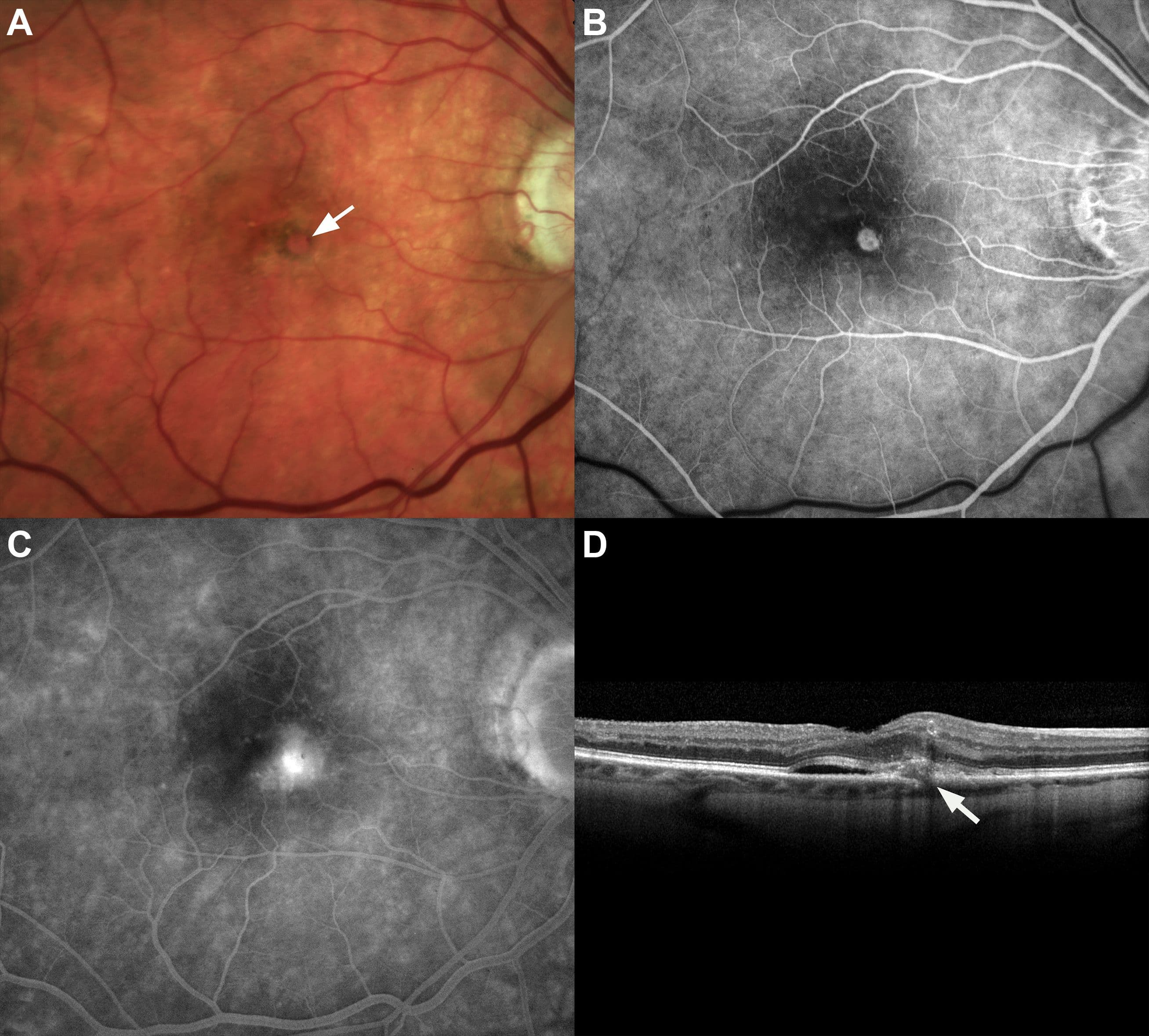 Ffa Amd How To Accurately Stage Age-Related Macular Degeneration with Cheat Sheet