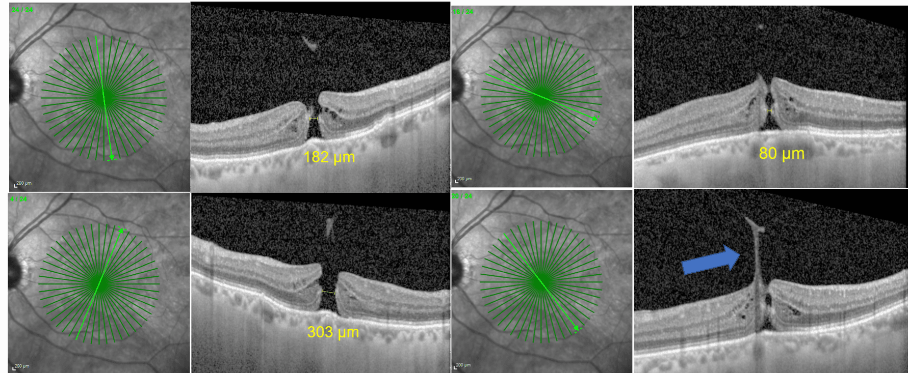 Step-by-Step Review and Pearls for Macular Hole Staging with Cheat Sheet