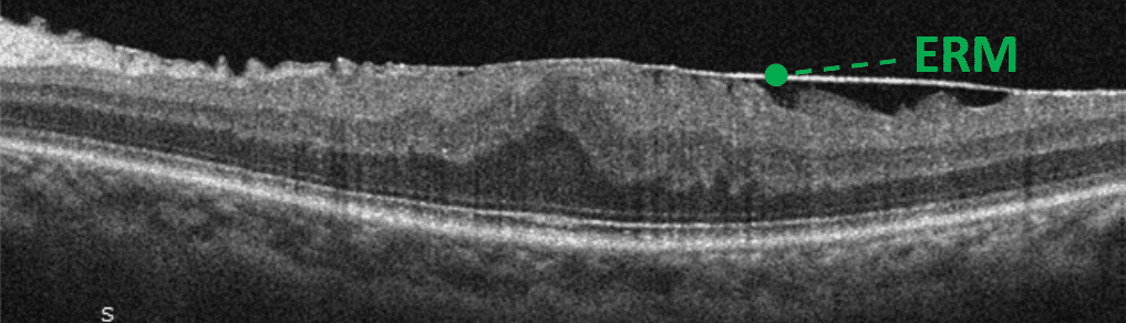 Into the Woods: Interpreting OCT Imaging in Retinal Disease