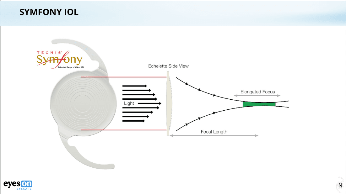 Apodized Iol The Webinar That Finally Got You Talking About Presbyopia-Correcting IOLs!
