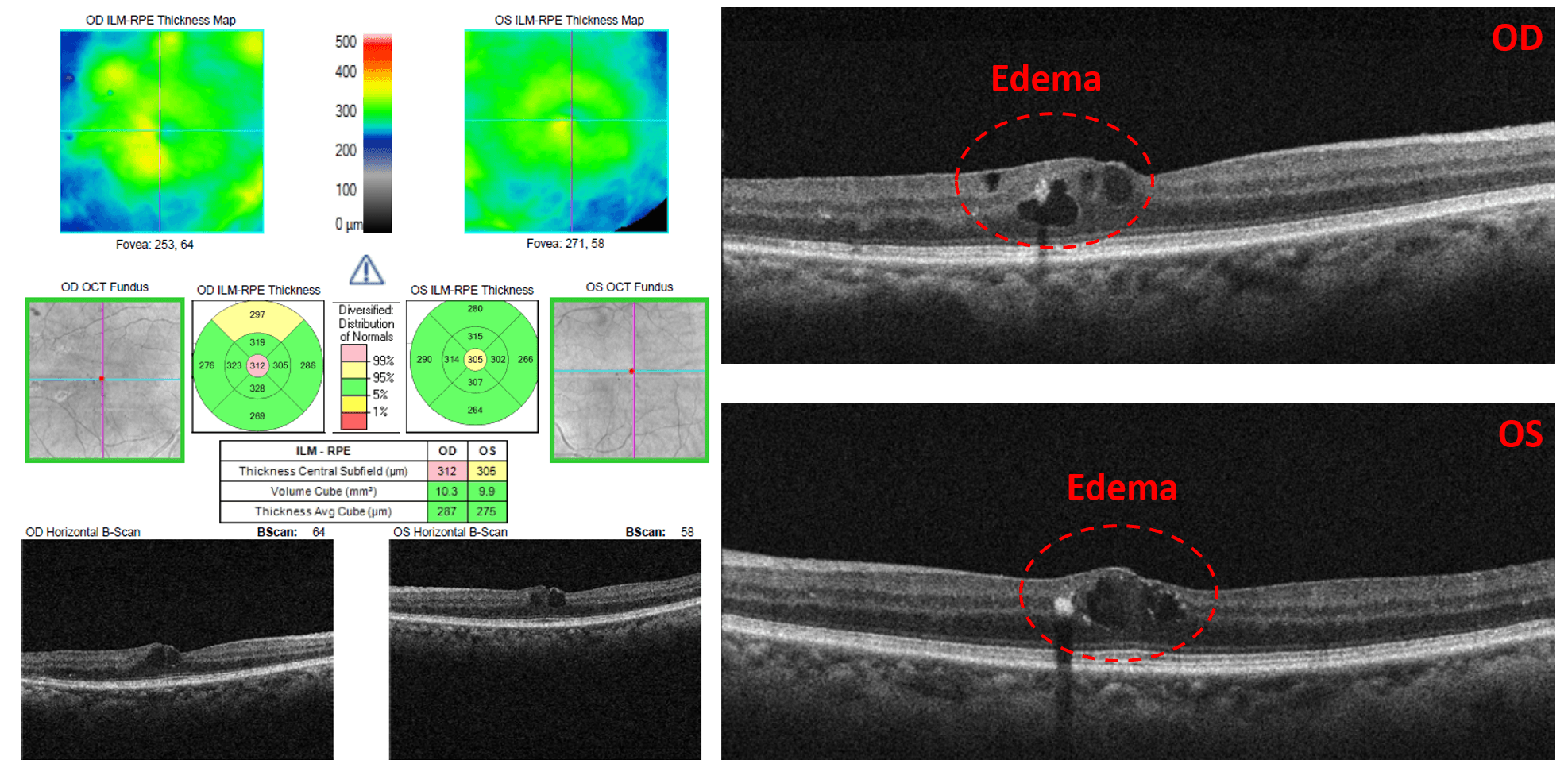 Into the Woods: Interpreting OCT Imaging in Retinal Disease
