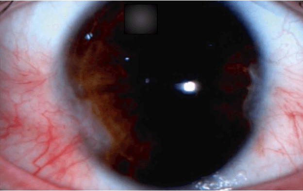 Exploring Surgical Approaches for Pterygium