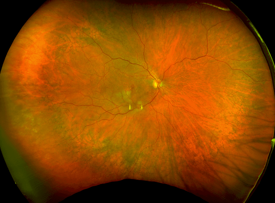 The Wide Spectrum of Peripheral Retinal Disease in AMD