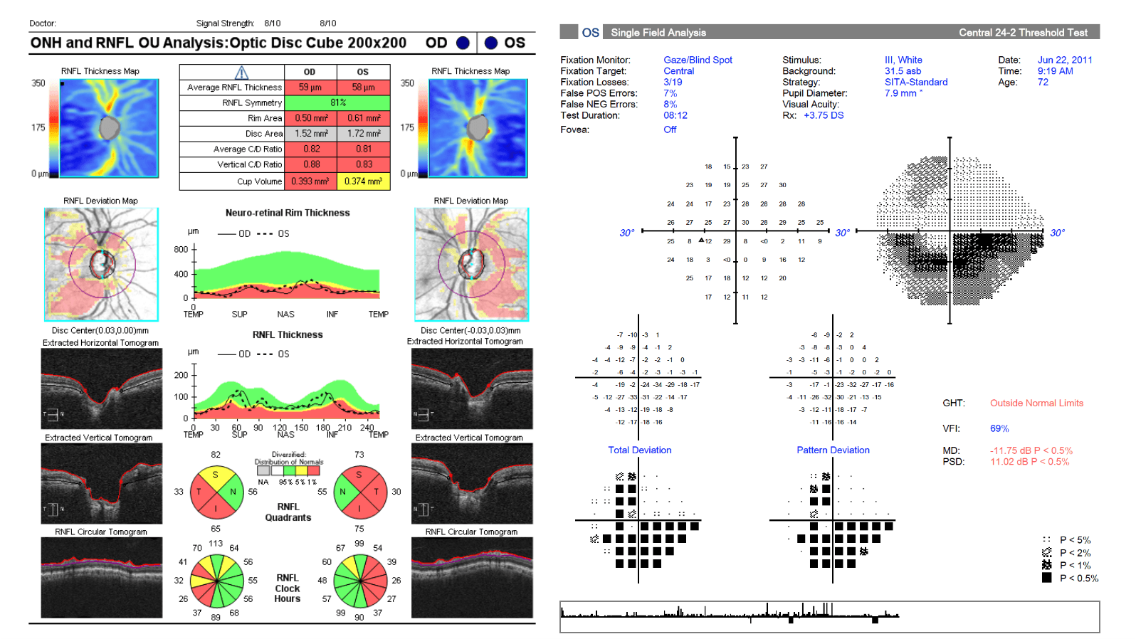 Multi Progression Visual Glaucoma Progression: Putting All the Pieces Together