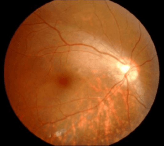 Disc Abnormal A Guide to Optic Disc Abnormalities with Cheat Sheet