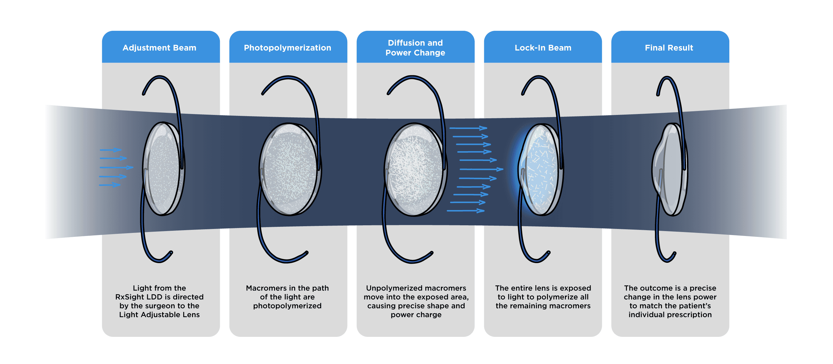 Light Lens Distance Changing The Ultimate Guide to the RxSight Light Adjustable Lens®