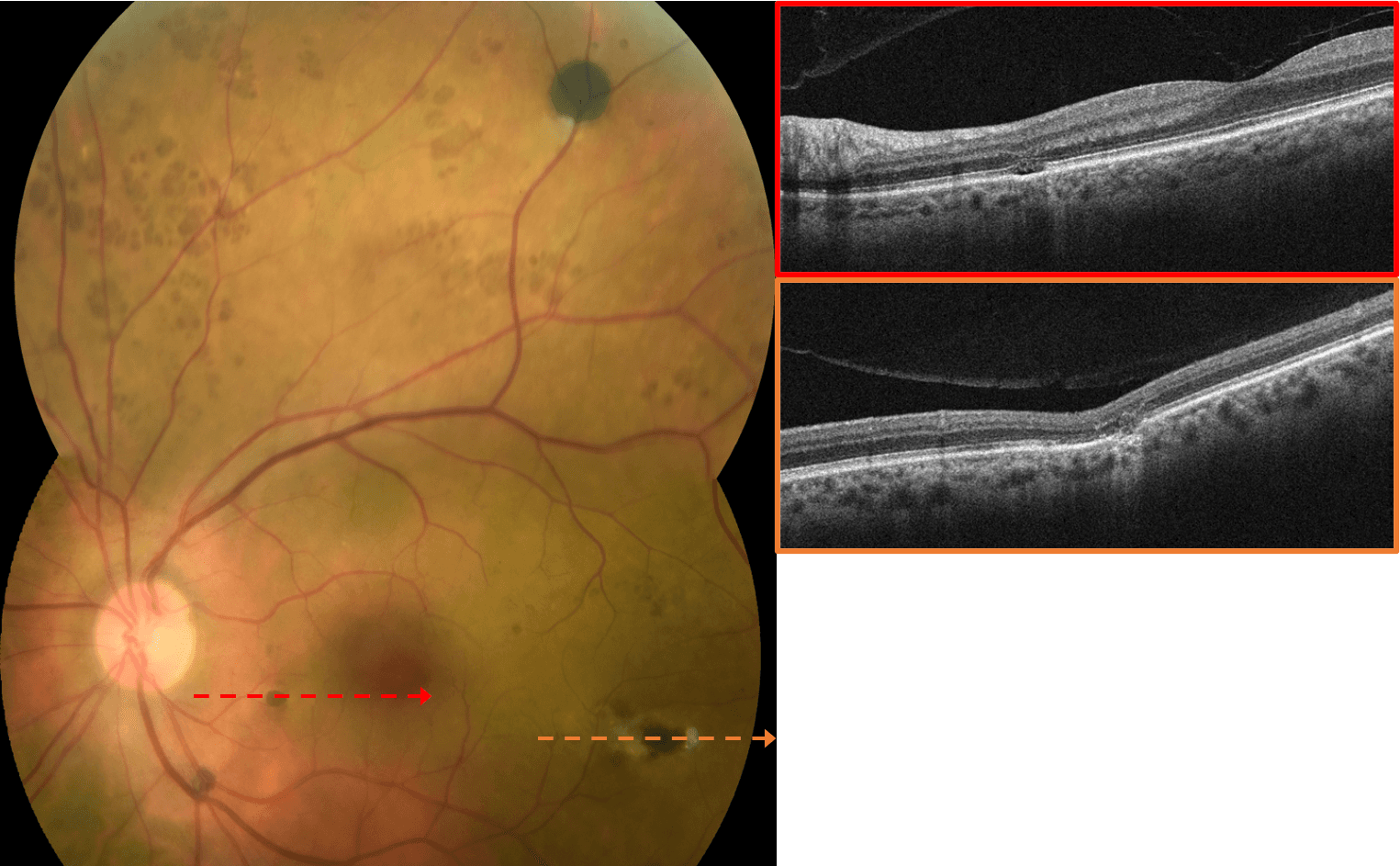 A Case Report on Familial Adenomatous Polyposis