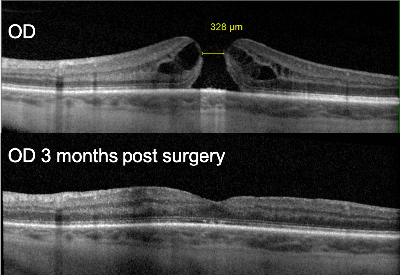 Step-by-Step Review and Pearls for Macular Hole Staging with Cheat Sheet