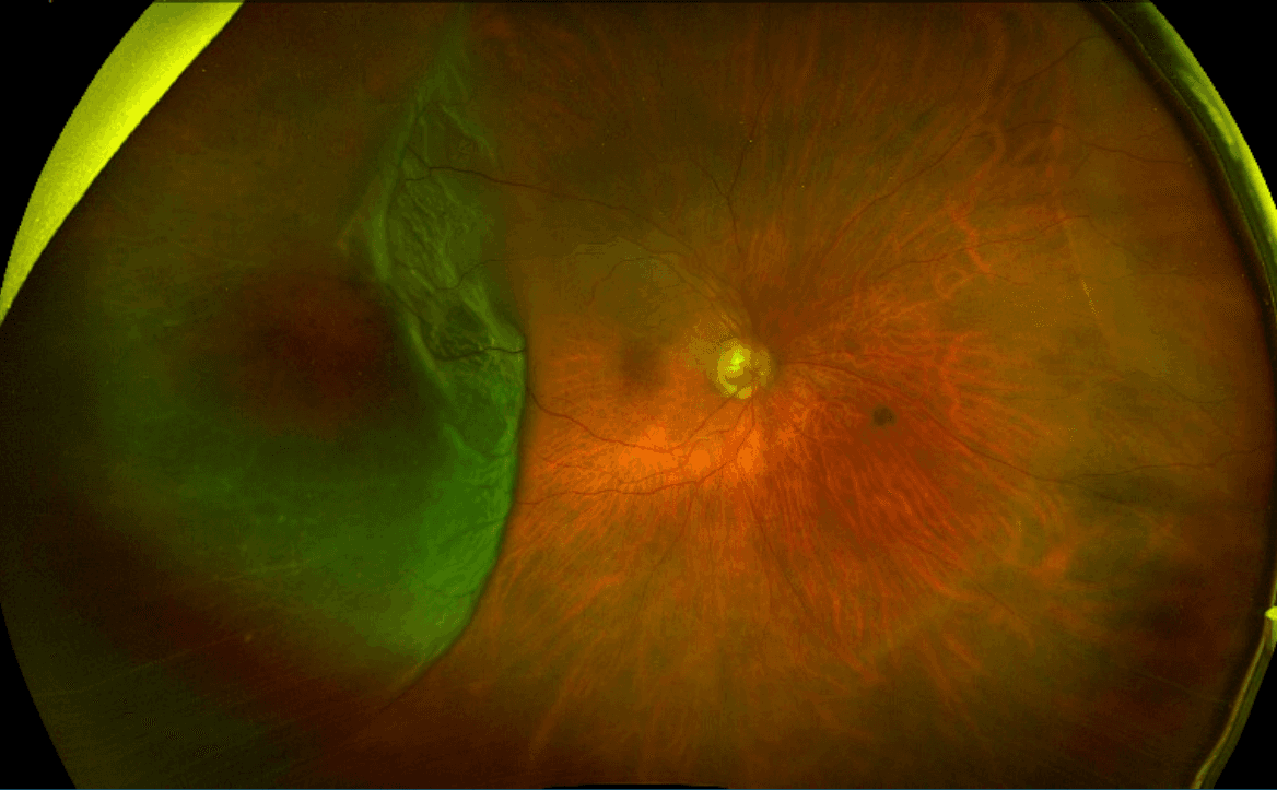 The OD's Guide to Identifying Peripheral Retinal Disease with Cheat Sheet