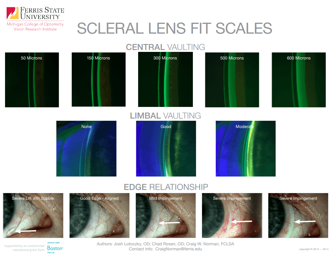 When Distorted Vision Happens: Troubleshooting the Scleral Fit