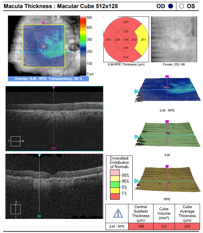 Notches Rpe Oct The Collaborative Dynamic in Geographic Atrophy Care